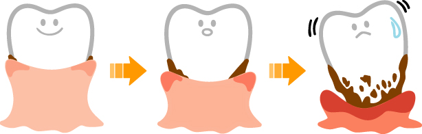 ひがしさわ歯科医院：歯周病菌は口腔内だけに止まらない